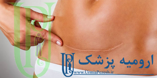 جراحی شکل دهی و طبیعی سازی فرم شکم در ارومیه